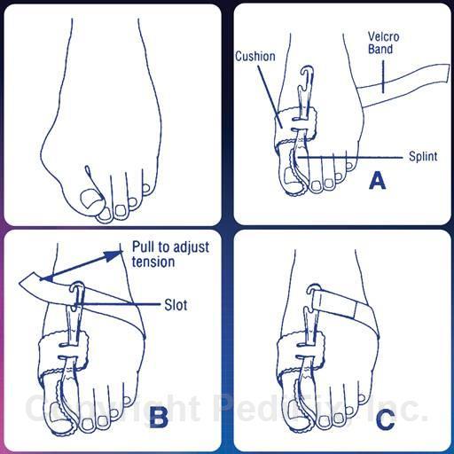 Nighttime Bunion Regulator P6035 - Pharmedico